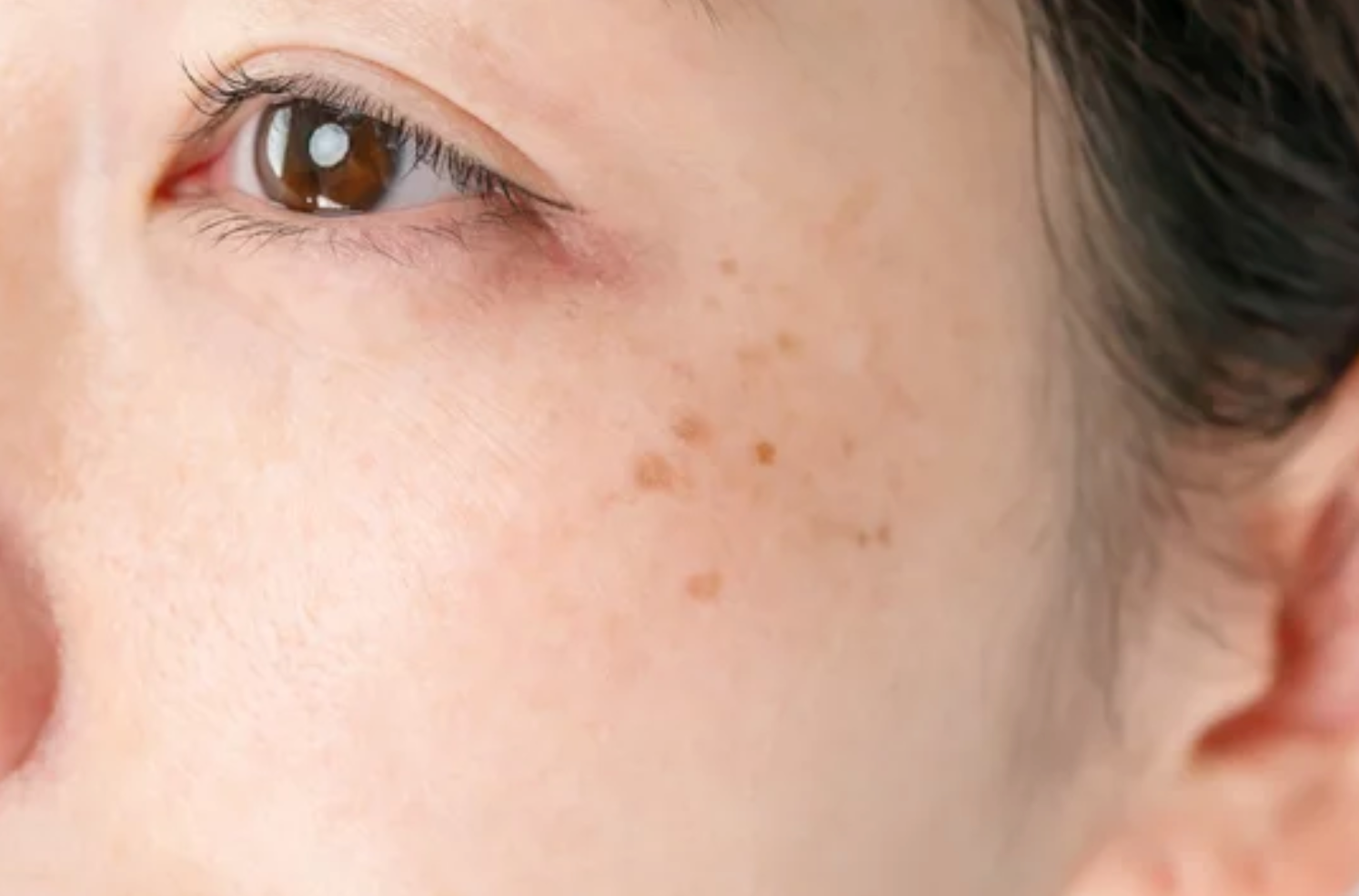 Hyperpigmentation: Understanding and Addressing Dark Spots